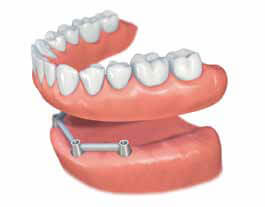 phuket dental, dental phuket, patong dental, phuket dental in thailand, implant center, dental implants