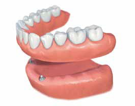 phuket dental, dental phuket, patong dental, phuket dental in thailand, dental implants, implant center