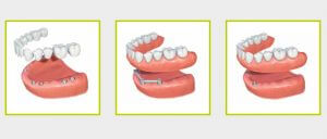 Phuket dental, Phuket dentist, Dental implant, Dental denture implant