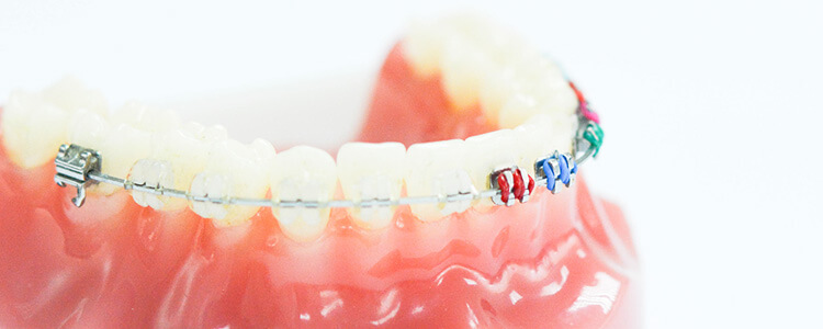 phuket dental, dental phuket, patong dental, phuket dental, orthodonic braces