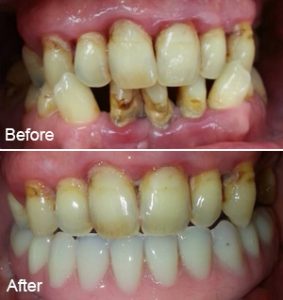 phuket dental, dental phuket, patong dental, dental implant, dental implant all on 4, phuket dental cosmetic