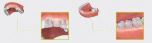 phuket dental, dental phuket, patong dental, phuket dental in thailand, dental implant, implant center