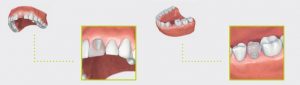 phuket dental, dental phuket, patong dental, phuket dental in thailand, dental implant, implant center