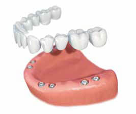 phuket dental, dental phuket, patong dental, phuket dental in thailand, dental implant, implant center