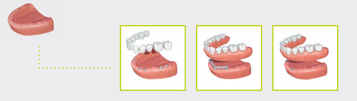 phuket dental, dental phuket, patong dental, phuket dental in thailand, dental implant, implant center