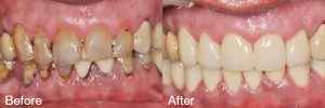phuket dental, dental phuket, patong dental, phuket dental root canal treatment, dental crowns