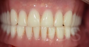 All-on-6 dental implant