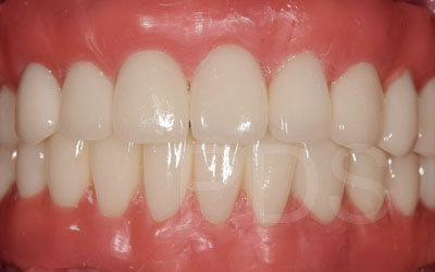 Dental Implant Overdentures