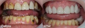 phuket dental, dental phuket, patong dental, phuket dental veneers, dental crowns