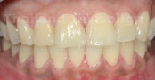 Invisalign Case 1 Front After