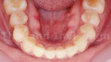 Invisalign Case 1 Lower After
