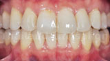 Invisalign Case 2 Front After