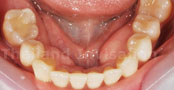 Invisalign Case 2 :Lower After