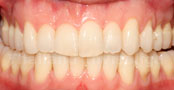Invisalign Case 3 Front After