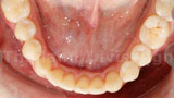Invisalign Case 3 Lower After