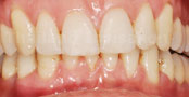 Invisalign Case 4 Front After