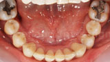Invisalign Case 4 Lower After